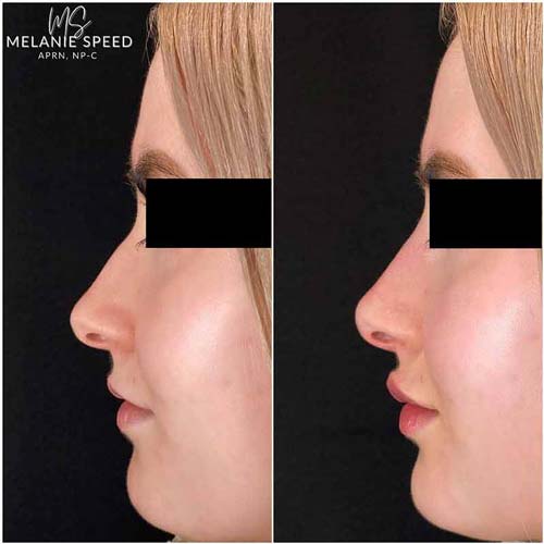 Nose Correction by Flawless Medspa