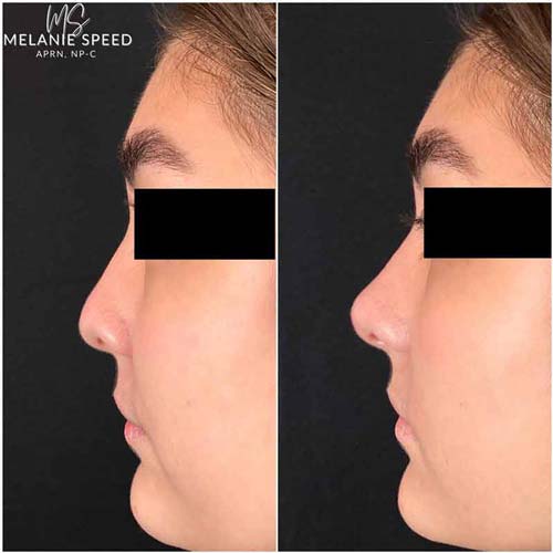 Nose Correction by Flawless Medspa