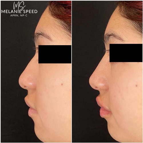 Nose Correction by Flawless Medspa