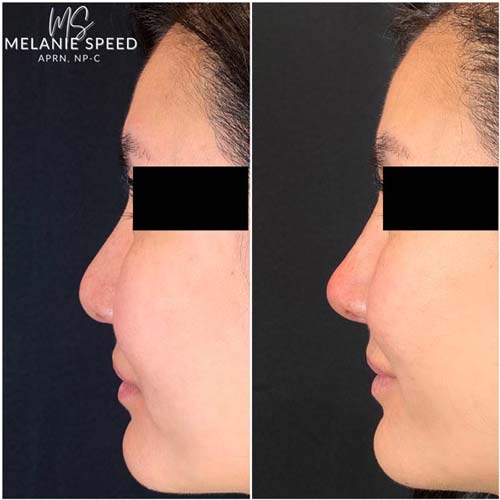 Nose Correction by Flawless Medspa