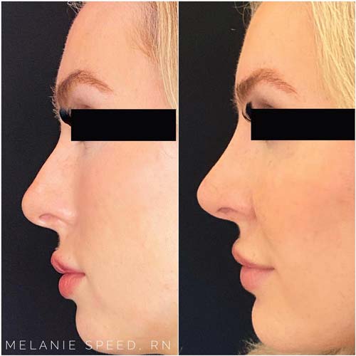 Nose Correction by Flawless Medspa