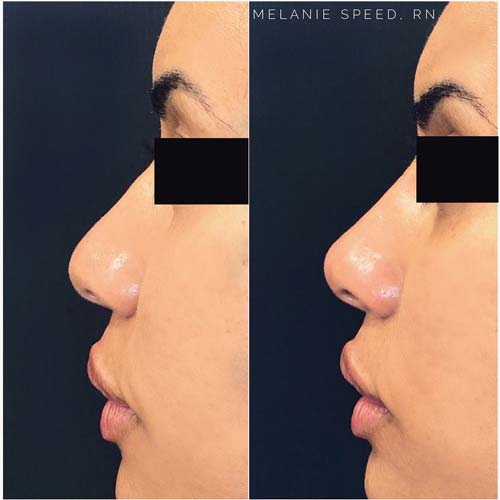 Nose Correction by Flawless Medspa