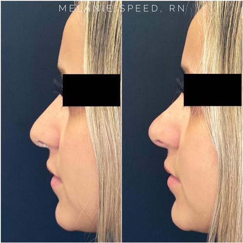 Non Surgical Nose Job Before and After at Flawless MedSpa & The Beverly Hills MedSpa in Beverly Hills, CA and Las Vegas, NV