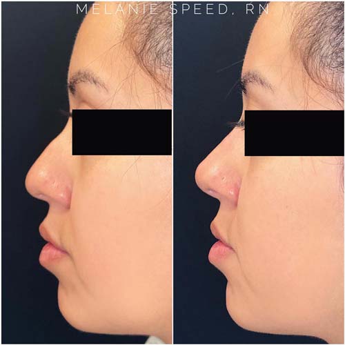 Nose Correction by Flawless Medspa