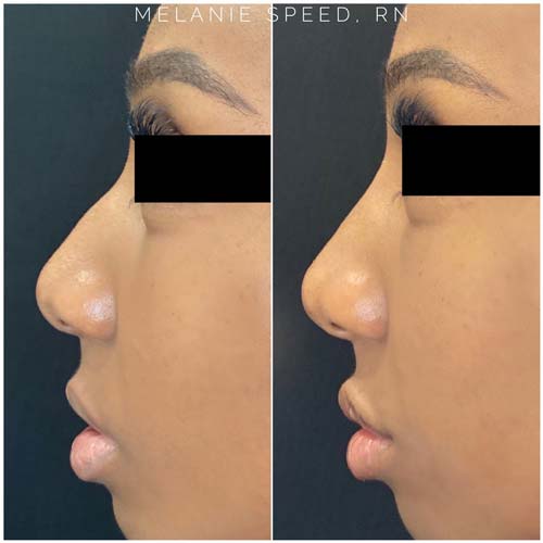 Nose Correction by Flawless Medspa