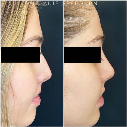 Nose Correction by Flawless Medspa