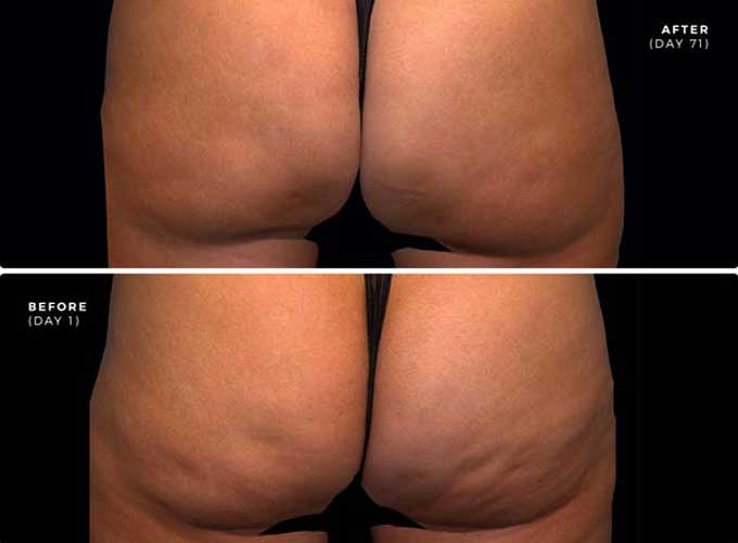 QWO Cellulite Treatment QWO Cellulite Treatment