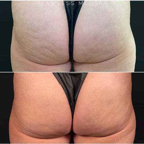 QWO Cellulite Treatment QWO Cellulite Treatment