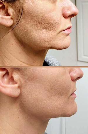 Scarlet SRF Treatment Specialist Near Me in Las Vegas NV Scarlet SRF Treatment Specialist Near Me in Las Vegas NV