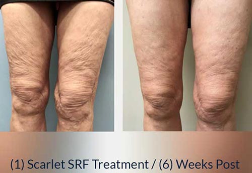 Scarlet SRF Treatment Specialist Near Me in Las Vegas NV