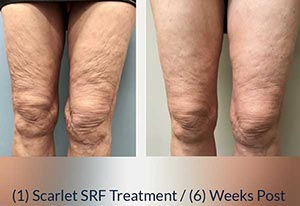 Scarlet SRF Treatment Specialist Near Me in Las Vegas NV Scarlet SRF Treatment Specialist Near Me in Las Vegas NV