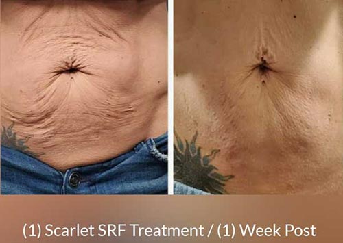 Scarlet SRF Treatment Specialist Near Me in Las Vegas NV