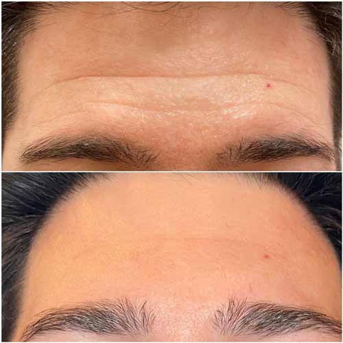 Sculptra Facial Rejuvenation by Flawless Medspa