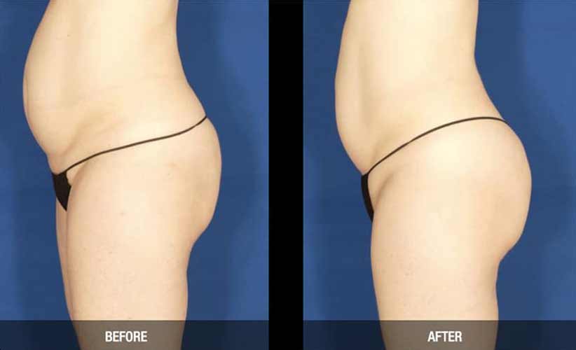 Ultrashape Permanent Fat Reduction by Flawless Medspa Ultrashape Permanent Fat Reduction by Flawless Medspa