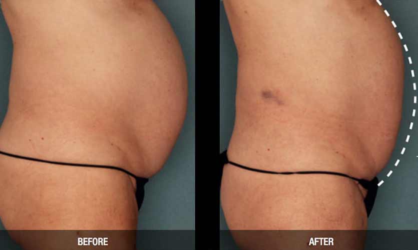 Ultrashape Permanent Fat Reduction by Flawless Medspa Ultrashape Permanent Fat Reduction by Flawless Medspa