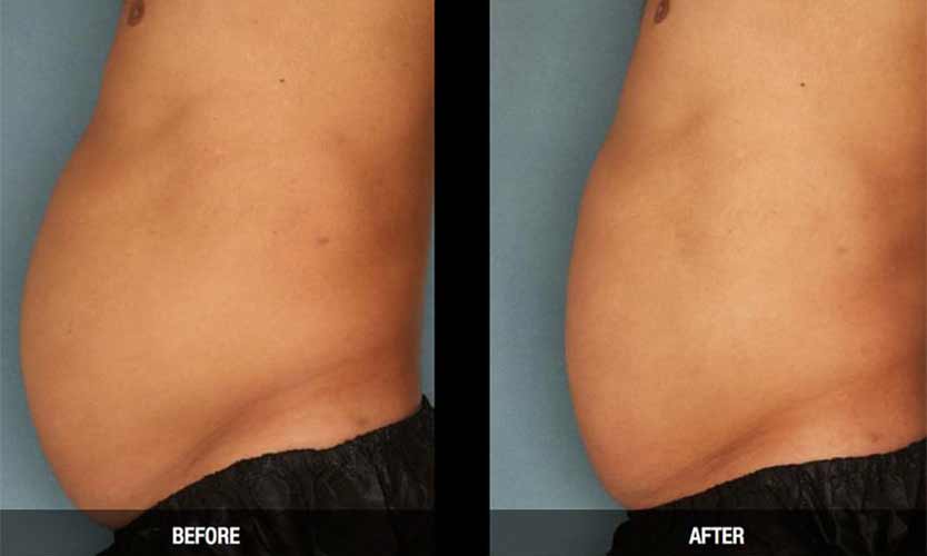 Ultrashape Permanent Fat Reduction by Flawless Medspa Ultrashape Permanent Fat Reduction by Flawless Medspa