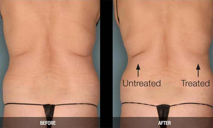Ultrashape Permanent Fat Reduction by Flawless Medspa Ultrashape Permanent Fat Reduction by Flawless Medspa