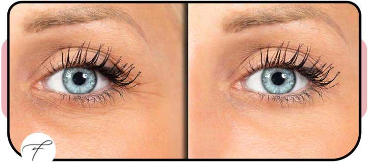Wrinkle Reduction Treatment in Las Vegas, NV Wrinkle Reduction Treatment in Las Vegas, NV