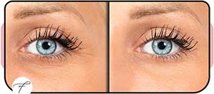 Wrinkle Reduction Treatment in Las Vegas, NV Wrinkle Reduction Treatment in Las Vegas, NV