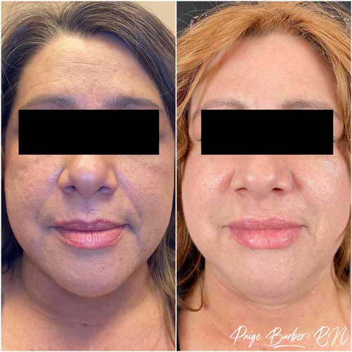 Chin & Jawline Correction by Flawless Medspa