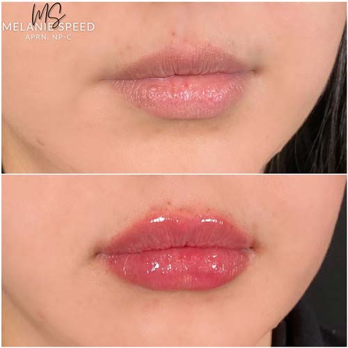 Lip Augmentation Before & After Photos by Flawless Medspa in Las Vegas NV