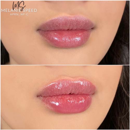 Lip Augmentation Before & After Photos by Flawless Medspa in Las Vegas NV