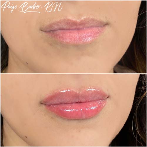 Lip Augmentation Before & After Photos by Flawless Medspa in Las Vegas NV