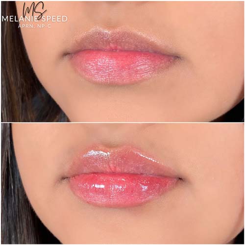 Lip Augmentation Before & After Photos by Flawless Medspa in Las Vegas NV