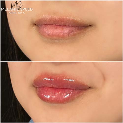 Lip Augmentation Before & After Photos by Flawless Medspa in Las Vegas NV