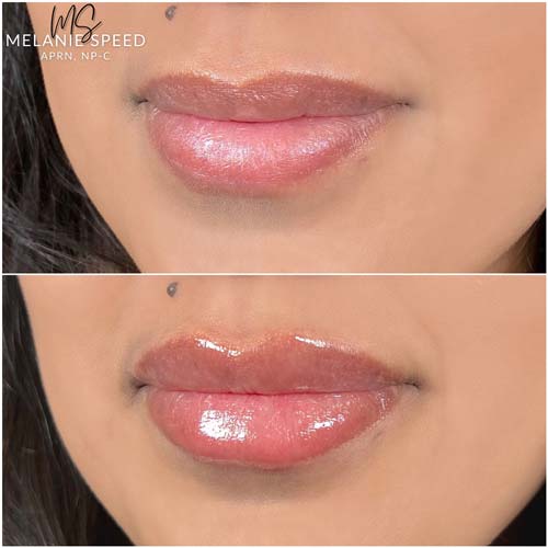 Lip Augmentation Before & After Photos by Flawless Medspa in Las Vegas NV