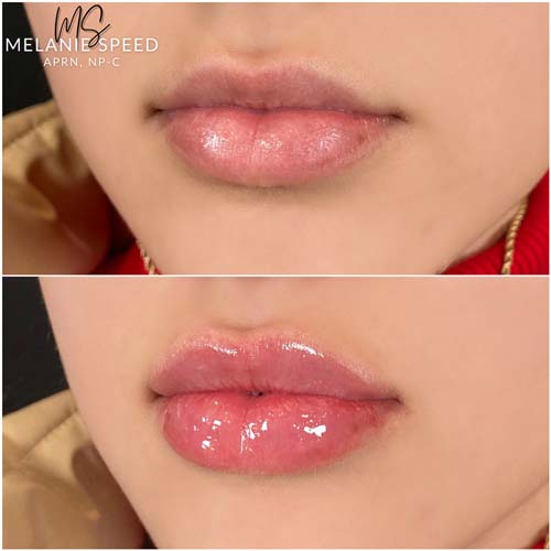 Lip Augmentation Before & After Photos by Flawless Medspa in Las Vegas NV