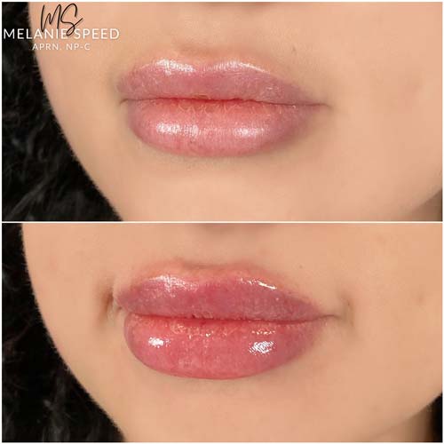 Lip Augmentation Before & After Photos by Flawless Medspa in Las Vegas NV