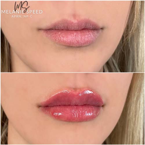 Lip Augmentation Before & After Photos by Flawless Medspa in Las Vegas NV