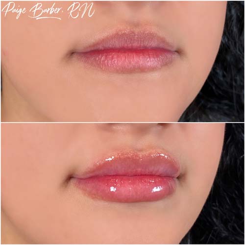 Lip Augmentation Before & After Photos by Flawless Medspa in Las Vegas NV