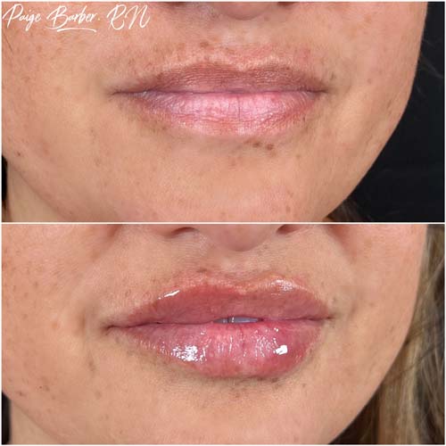 Lip Augmentation Before & After Photos by Flawless Medspa in Las Vegas NV