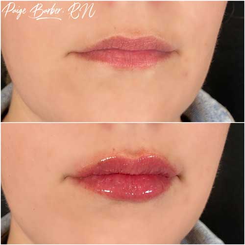 Lip Augmentation Before & After Photos by Flawless Medspa in Las Vegas NV