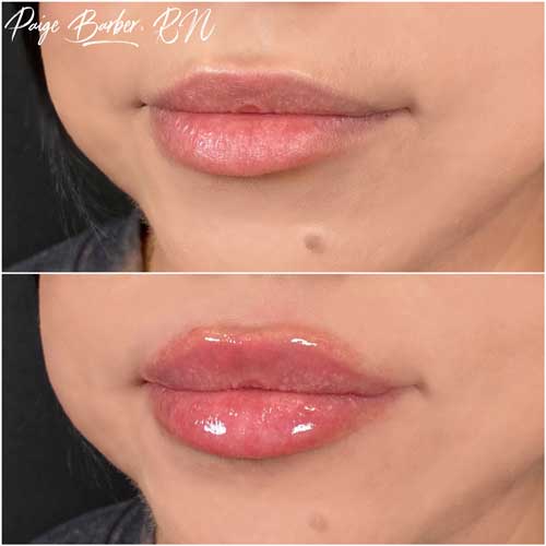 Lip Augmentation Before & After Photos by Flawless Medspa in Las Vegas NV