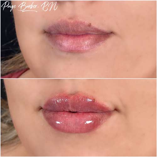 Lip Augmentation Before & After Photos by Flawless Medspa in Las Vegas NV