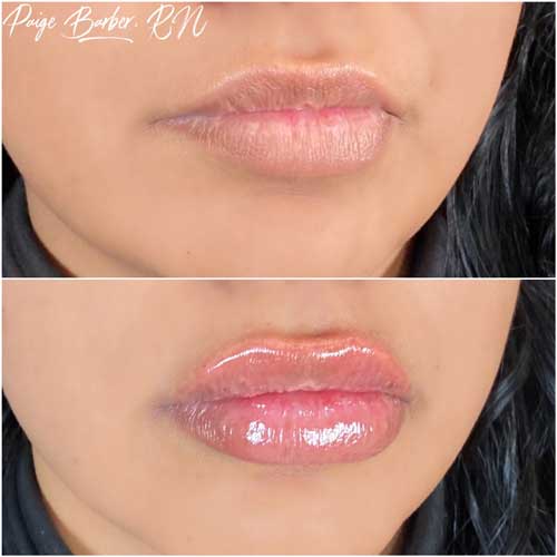 Lip Augmentation Before & After Photos by Flawless Medspa in Las Vegas NV