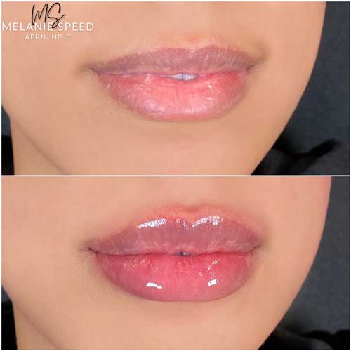 Lip Augmentation Before & After Photos by Flawless Medspa in Las Vegas NV