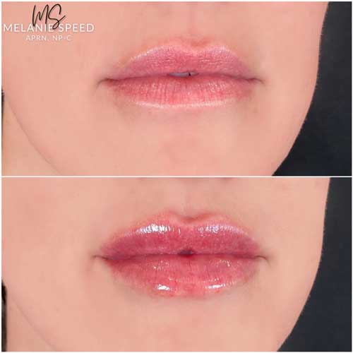 Lip Augmentation Before & After Photos by Flawless Medspa in Las Vegas NV