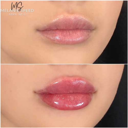 Lip Augmentation Before & After Photos by Flawless Medspa in Las Vegas NV