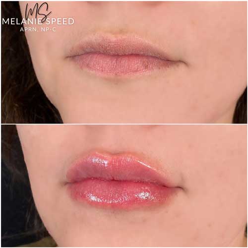 Lip Augmentation Before & After Photos by Flawless Medspa in Las Vegas NV