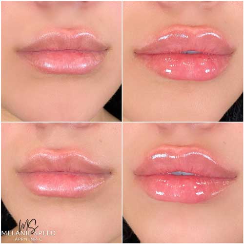 Lip Augmentation Before & After Photos by Flawless Medspa in Las Vegas NV