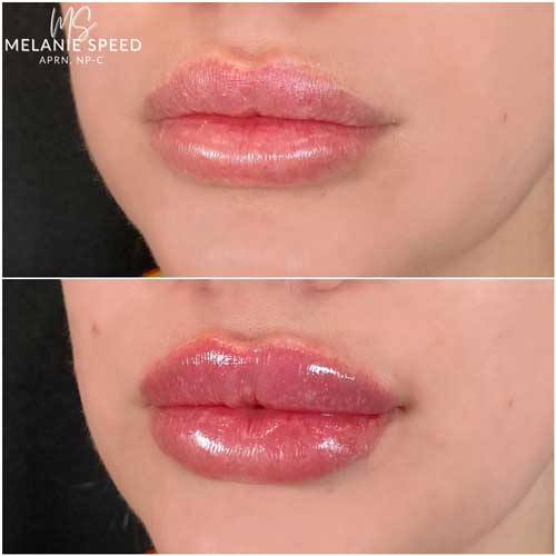 Lip Augmentation Before & After Photos by Flawless Medspa in Las Vegas NV