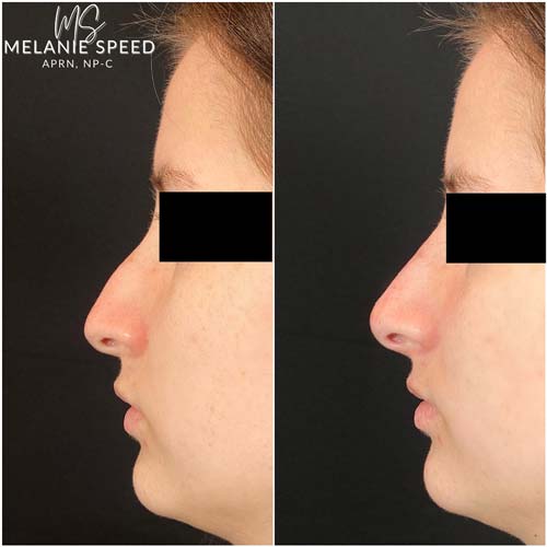 Nose Correction by Flawless Medspa