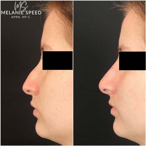 Nose Correction by Flawless Medspa Nose Correction by Flawless Medspa