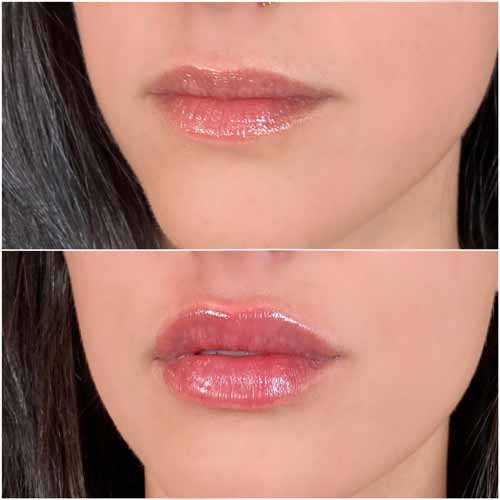 Lip Augmentation Before & After Photos by Flawless Medspa in Las Vegas NV