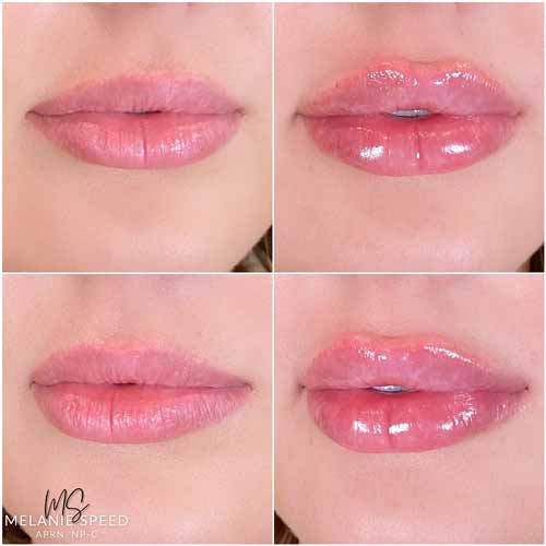 Lip Augmentation Before & After Photos by Flawless Medspa in Las Vegas NV