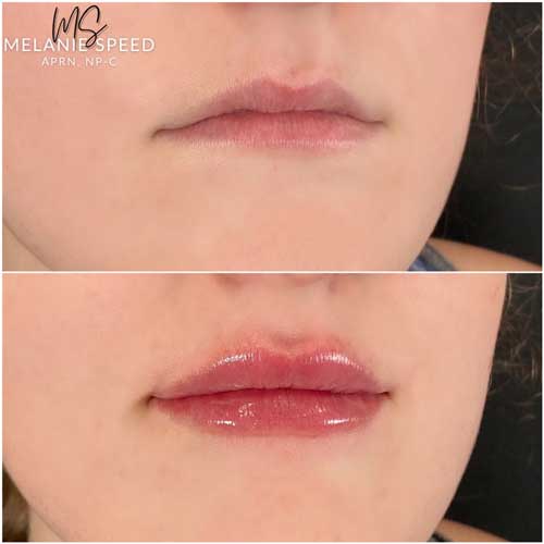 Lip Augmentation Before & After Photos by Flawless Medspa in Las Vegas NV